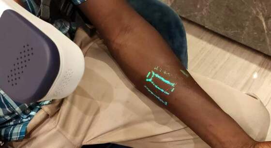 Medical Portable Vein Finder Machine